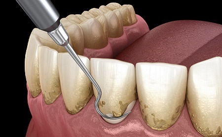 Las preguntas mas frecuentes sobre la periodontitis - Espacio Dental Jaén