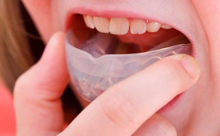 Cómo cuidar tu protector bucal - Espacio Dental Jaén