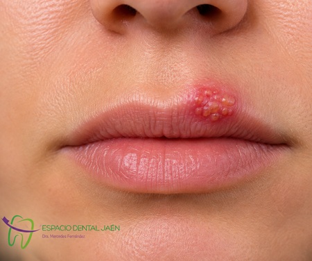 Dolor causado por herpes recidivante - Espacio Dental Jaén