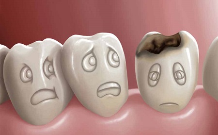 Por qué se pican los dientes - Espacio Dental Jaén