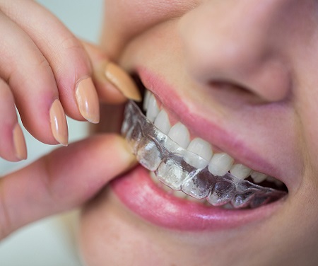 Sonríe con confianza: corrige la posición de tus dientes con ortodoncia  invisible - Espacio Dental Jaén