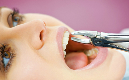 Qué hacer después de una extracción dental - Espacio Dental Jaén