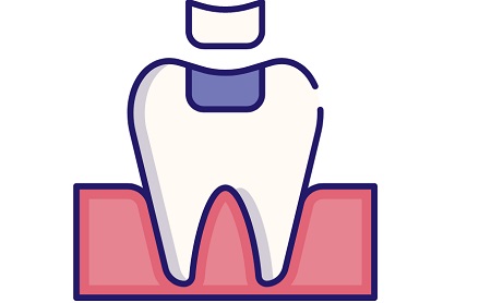 ¿Qué es una incrustación dental? - Espacio Dental Jaén