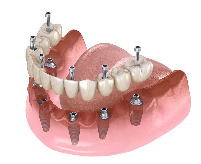 Perceptivo Juguetón organizar Todo lo que debes saber sobre los implantes dentales | Espacio Dental Jaén