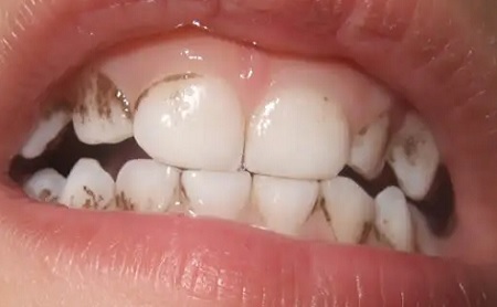 ¿Por qué se me tiñen los dientes? - Espacio Dental Jaén