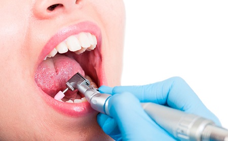 Ventajas de hacerte regularmente una limpieza de boca - Espacio Dental Jaén