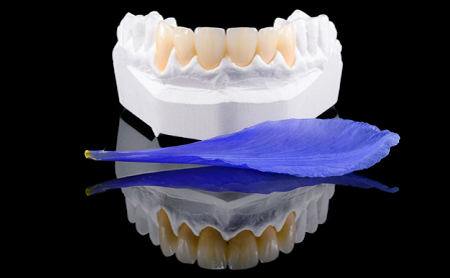 Ventajas de las Carillas de Composite Inyectado - Espacio Dental Jaén