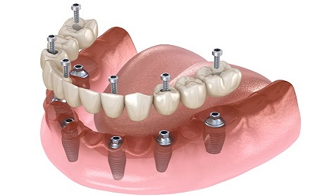 Implantes dentales en Jaén en Espacio Dental Jaén