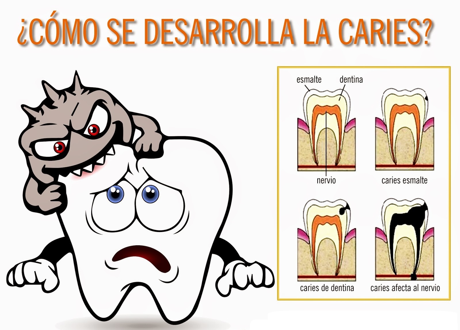 Etapas de la Caries Dental - Dentista Jaén | Espacio Dental Jaén