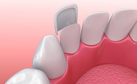 Carillas dentales - Espacio Dental Jaén