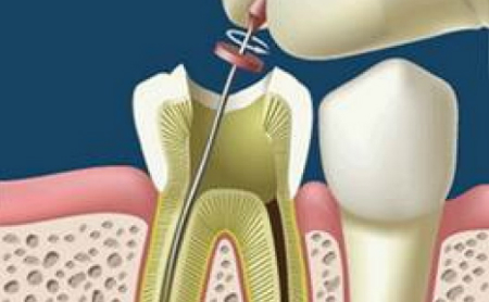 Tratamientos de Endodoncia en Jaén en Espacio Dental en Jaén