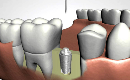 Tratamientos de Implantes Dentales en Jaén en Espacio Dental Jaén